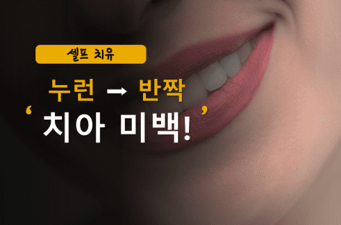 이빨 하얘지는법 적용 후 환하게 웃고 있는 여자