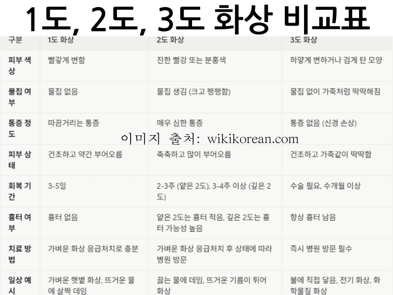 가벼운 화상 응급처치: 1도, 2도, 3도 화상 비교표(피부 색상, 물집 여부, 통증 정도, 피부 상태, 회복 기간, 흉터 기간, 흉터 여부, 치료 방법, 일상 예시)