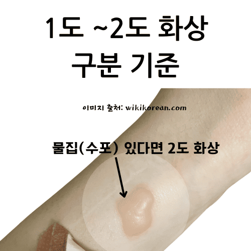 가벼운 화상 응급처치 시 확인해야 하는 2도 화상 물집(수포) 있는 경우