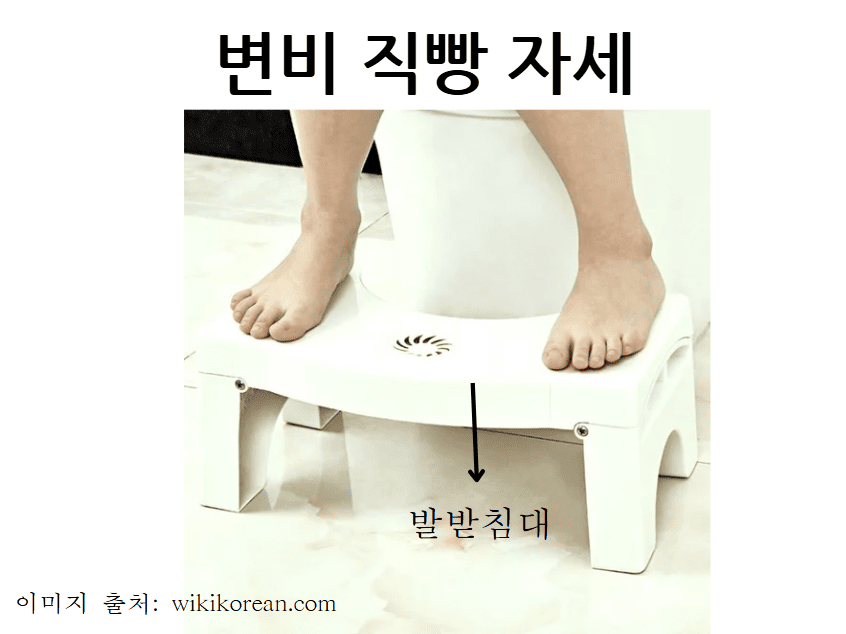 시원하게 변비 탈출하는 변비 직빵 자세: 영변기 아래 발 받침대